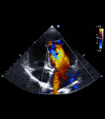 Doppler Ultrason Nedir? Niçin Yapılır?